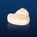 Multilayerd Full Zirconia Dental Restoration